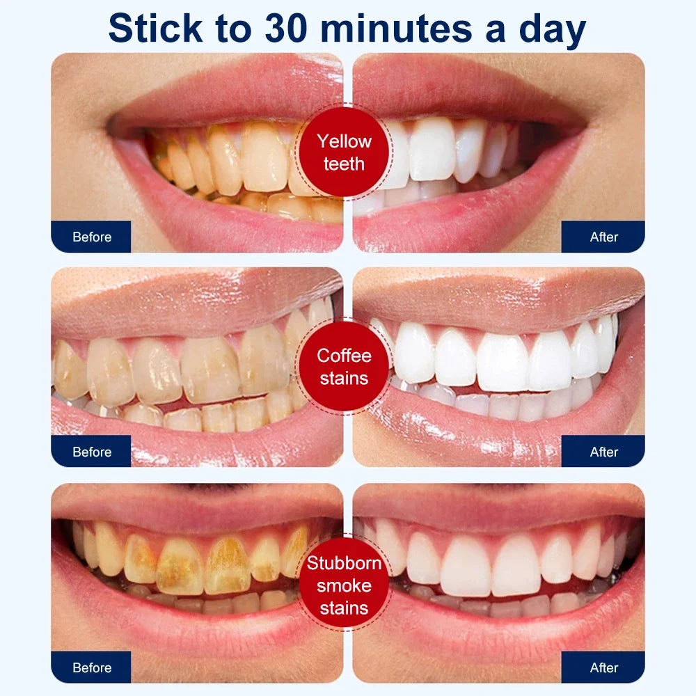 Teeth Whitening Kit – Strips & Gel for a Brighter Smile