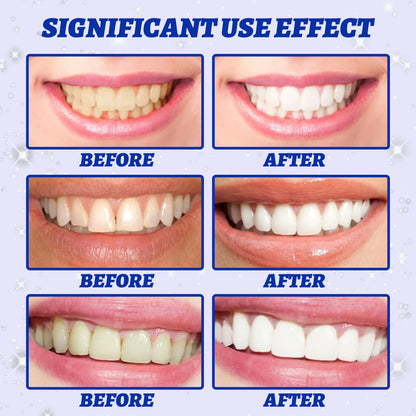 Teeth Whitening Kit – Strips & Gel for a Brighter Smile
