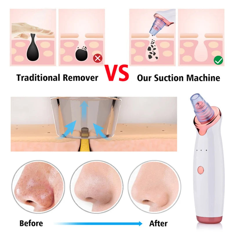 Blackhead Remover Vacuum – Electric Pore Cleanser for Clear Skin